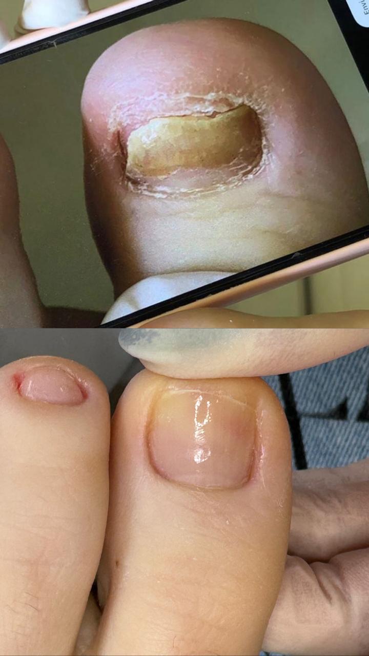 Antes e depois de tratamento de unha em Cuiabá