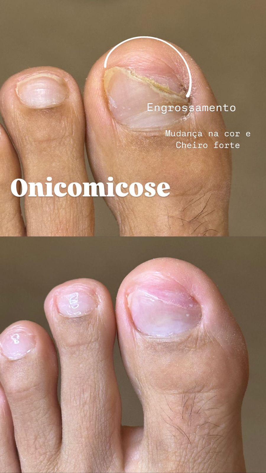 Antes e depois de tratamento de onicomicose