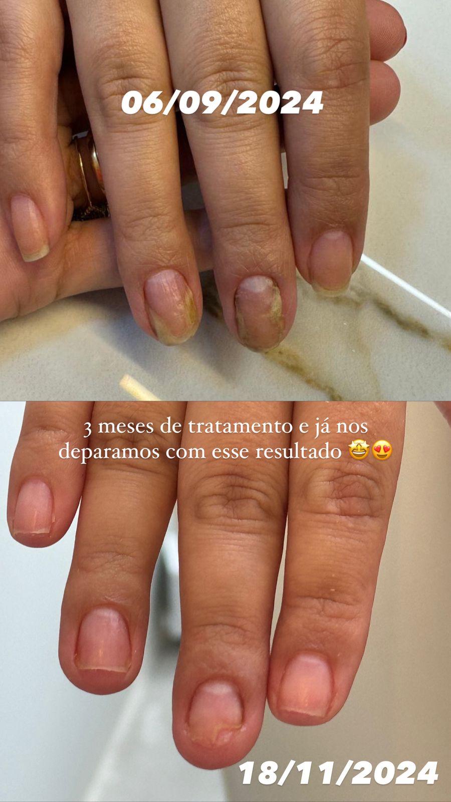Antes e depois de tratamento de unhas, resultado em 3 meses